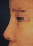 Beautiful Nose revision with Topface via Misooda.com