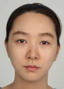 Cheekbones reduction, incision eyelid surgery , fat grafting, nose revision surgery