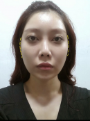 New V-Line, Zygoma Reduction & Rhinoplasty & Fat Graft