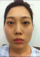 New V-Line, Zygoma Reduction & Rhinoplasty & Fat Graft