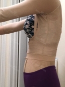 It's been 2 weeks since my surgery and I am recovering well! I flew back to Canada with no issues and removed my stitches at a local clinic. I am also using scar cream and tape for my breast augmentation incisions. The scar doesn't look bad and blends with the shadow under my boob!! My doctor (Dong Jin Choi) is the best~