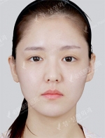 facial contouring