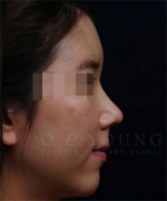 facial contouring
