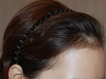hairline