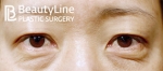 eye surgery