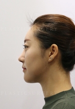 facial contouring