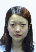 Rhinoplasty