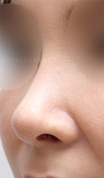 Rhinoplasty