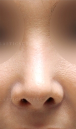 Rhinoplasty