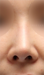 Rhinoplasty