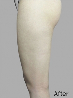 Liposuction