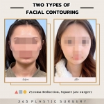 Two types of facial contouring