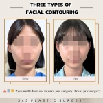Three types of facial contouring