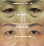 Lower Blepharoplasty / park sang hyun