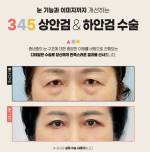 Lower Blepharoplasty