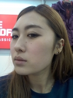 Rhinoplasty and lovely results!