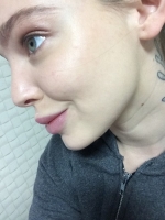 UK Model PIXIEE's skin treatment in Korea