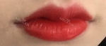 Lips Augmentation & Mouth Corner Lift Filler