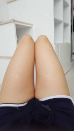 Thighs liposuction