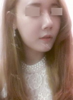 Rhinoplasty~!