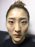 eye, nose, micro fat grafting, facial bone contouring surgery