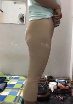 Thigh Liposuction+Calf Botox