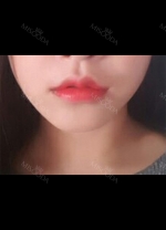 I had Smile lip lifting, Cupid’s bow lip and lip tubercle surgeries in Hyundai Aesthetics