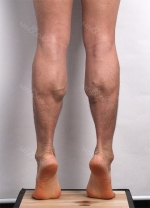 Calf muscle reduction