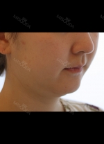 facial liposuction