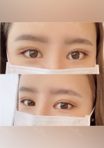 Double eyelids revision : 2 weeks at Wonjin!