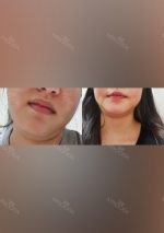 Facial liposuction, Thread Lifting