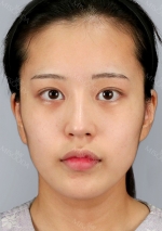 Facial Contour, Chin Reduction, Fat Graft ~!!