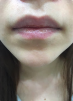 Lip(corner) filler injection