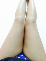 Hip line thigh liposuction