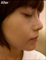 Nasal Hump Reduction & Nasal tip Reduction