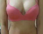 Teardrop implant breast augmentation