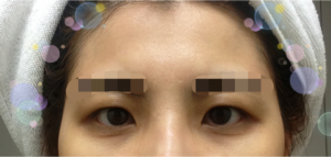 Hidden eyelids and Forehead fat grafting