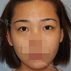 Incisional Double Eyelid, Lateral Canthoplasty, Eyelid Fat Removal