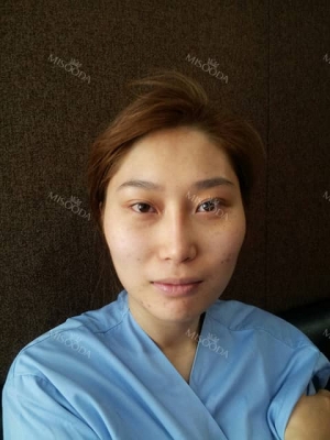 Scarless Smooth Face Line with Endoscopic Face Contouring by Romian