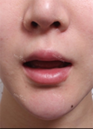 Lips and Fat Graft