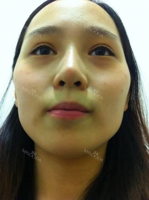 Facial Contouring Surgery+Square Jaw Reduction,+Chin Reduction,+Zygoma Reduction+Full face fat graft