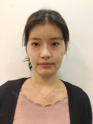I got surgery at eyes, nose as reoperation and bon contour surgery, fat graft with Jewelry surgery center.