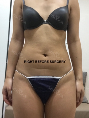 Liposuction and Breast Augmentation