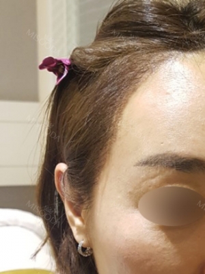 My Hairline Hair Transplant Surgery in Yonsei Hair Transplant clinic