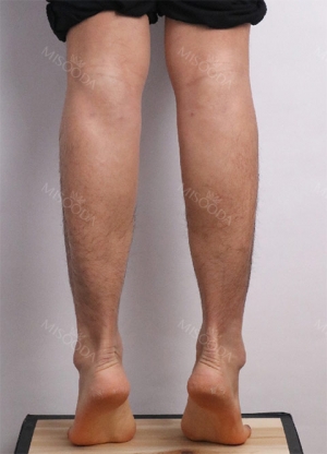 Calf muscle reduction