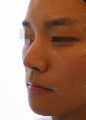 Nose surgery 3 months
