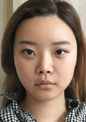 Yepoong-ee’s Plastic Surgery Real Review