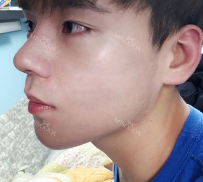 Wannabe Plastic Surgery, Reviews,Images, Promotions — Korea cost, reviews & before-after | MISOODA