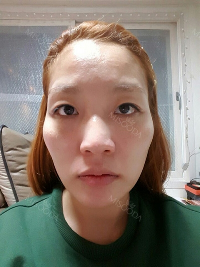 Cinderella Plastic Surgery,Reviews,Images,Promotions — Korea cost, reviews & before-after | MISOODA