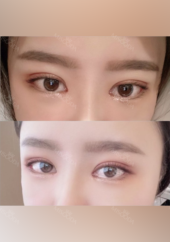 Double eyelids revision : 2 weeks at REN!